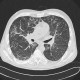 Atypical pneumonia: CT - Computed tomography
